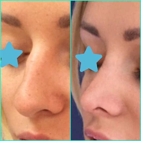 Bulbous Nose Tip Before And After » Rhinoplasty: Cost, Pics, Reviews, Q&A