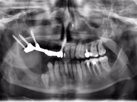 Implantes Basales Siesi