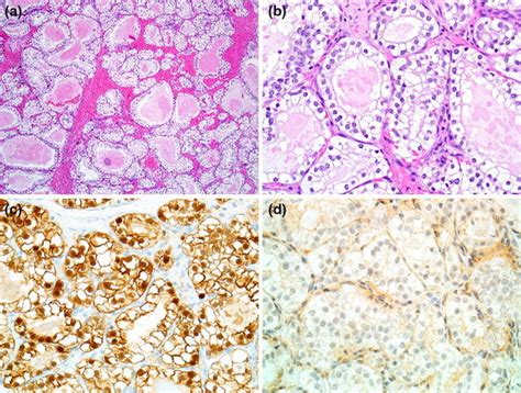 Sinonasal Renal Cell Like Adenocarcinoma Grows As Nests And Follicles