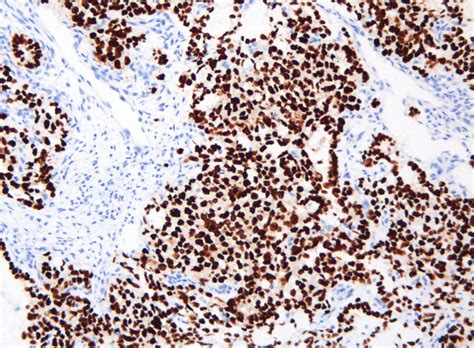 Pathology Outlines Yolk Sac Tumor