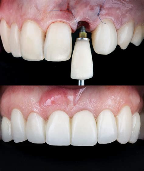 Cicatrização Implante Dentário Antes E Depois - Implante Dentario Antes Depois Antes E Depois De Um Implante