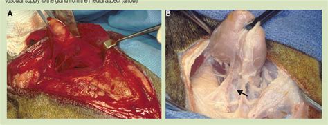 Figure 3 From Surgery For Cervical Sublingual And Pharyngeal Mucocele