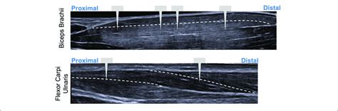 Illustration Showing Extended Field Of View Ultrasound Images With