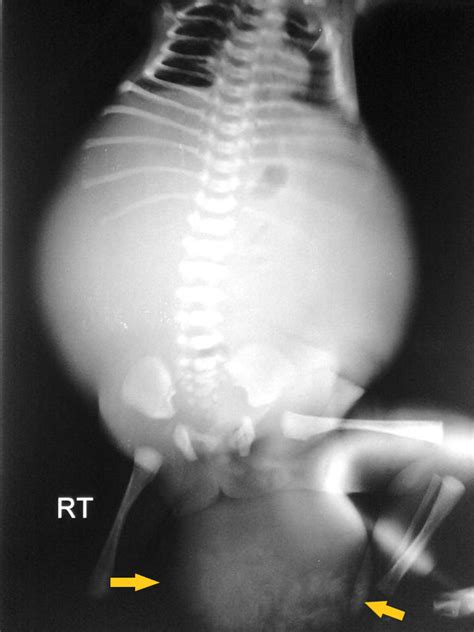 Sacrococcygeal teratoma x ray - wikidoc