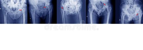 X-ray Image of Painful Hip in Woman Present Fracture Right Hip Joint at ...