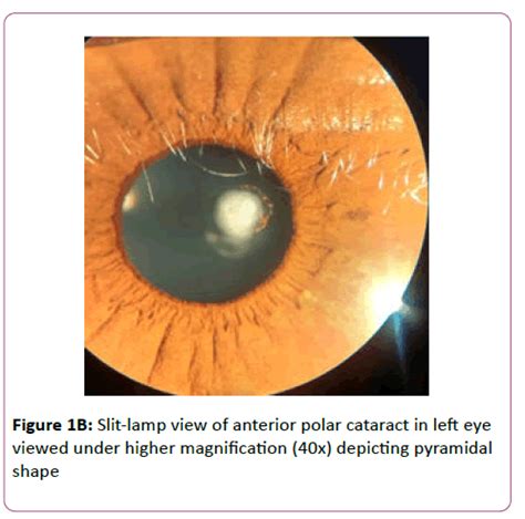 Anterior Polar Cataract