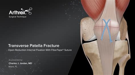 Arthrex Transverse Patella Fracture Open Reduction Internal Fixation