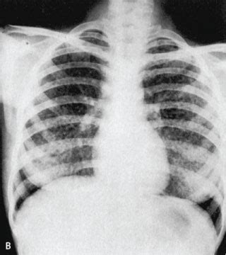 Tropical Pulmonary Eosinophilia An Epidemiological And Clinical Review