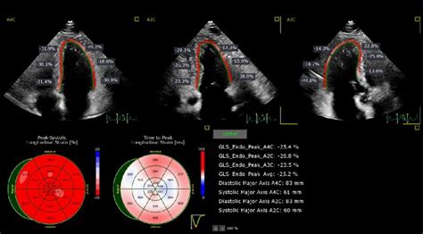 Myocardial Strain Imaging Cardiology Lee Health Heart Institute