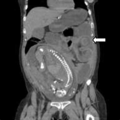 Coronal View Of The Ct Scan Showing Intussusception White