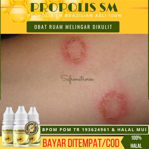 Jual Obat Ruam Melingkar Di Kulit Tinea Corporis Gatal Berbentuk