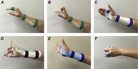 Extensor Tendon Injuries of the Hand - Physiopedia