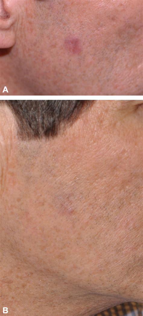 Primary Cutaneous B Cell Lymphomas Journal Of The American Academy Of Dermatology