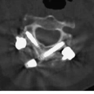 Postoperative CT Showing Accurate Placement Of C2 Laminar Screws