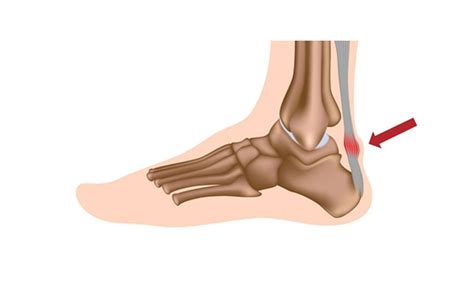 Achilles Tendinopathy Forest Podiatry