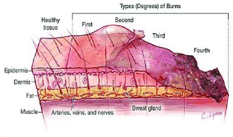 Fourth Degree Burn Diagram