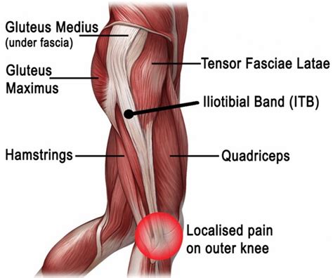 Iliotibial Band Syndrome Triangle Physiotherapy