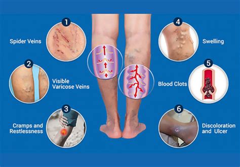 Endovenous Laser Ablation – Eravio Hospital