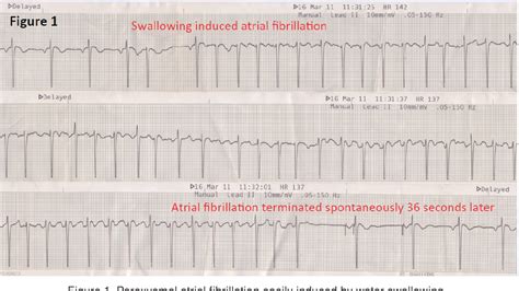 Paroxysmal Atrial Fibrillation