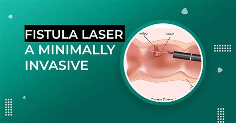 Fistula Laser Treatment A Minimally Invasive Solution