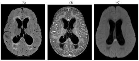 Pediatric Reports Free Full Text A Fatal Case Of Tuberculosis Meningitis In Previously