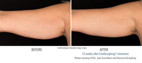 CoolSculpting Elite Before And After New Treatment And Better Results