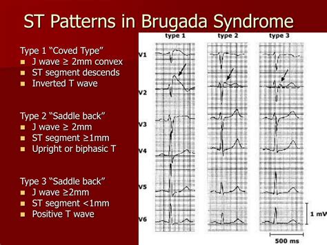 Brugada Syndrome What To Know