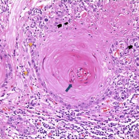 Histologic Image Of Oral Squamous Cell Carcinoma Hematoxylin Eosin