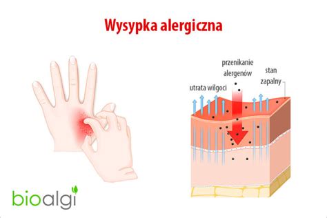 Wysypka Alergiczna Bioalgi