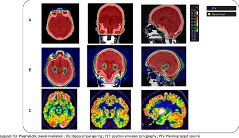 Impact Of Prophylactic Cranial Irradiation And Hippocampal Sparing On