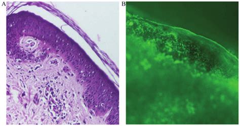 Miscrocopy Observation Of Lesion Biopsies A Hematoxylin And Eosin