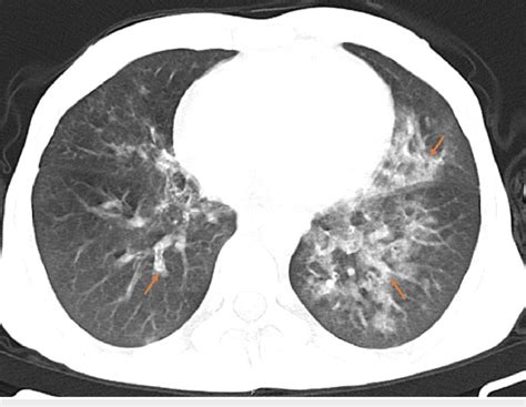 Axial Computed Tomography Ct Scan Of The Thorax Showing Bilateral Download Scientific Diagram