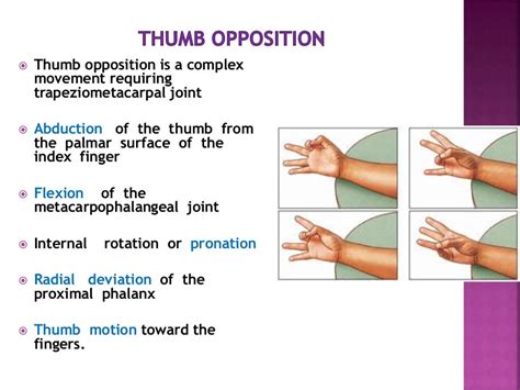 Ape thumb deformity to publish