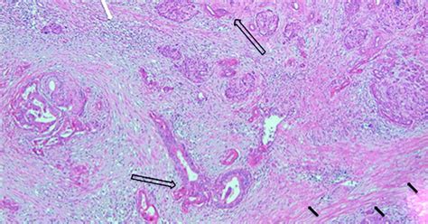 Cancer Cells - Hirshberg Foundation for Pancreatic Cancer Research