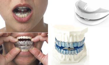 Mandibular Advancement Splint MAS About Snoring