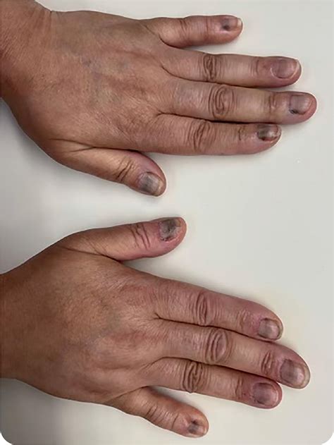 Arsenic Poisoning Fingernail Signs