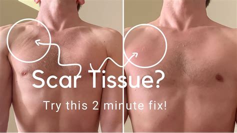 ERASE SCAR TISSUE In 2 Minutes YouTube