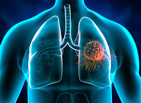 Lung cancer - can it be prevented?