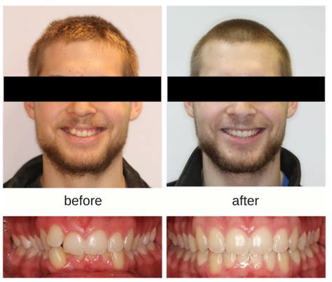 Invisalign Jaw Alignment Before And After Before And After