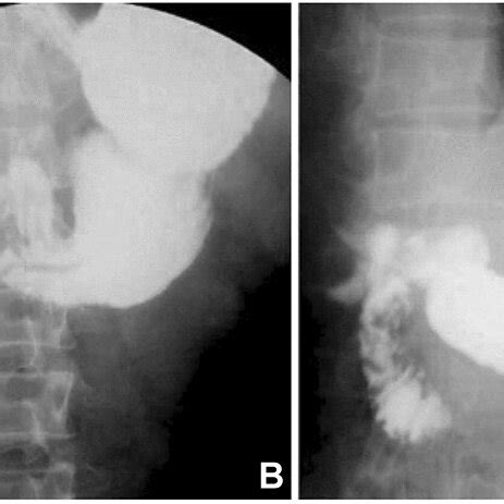 Case 7 Placement Of Duodenal Decompression Tube And Jejunal Feeding