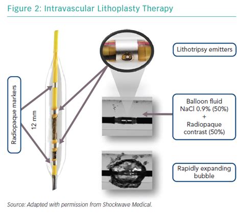 Intravascular Lithoplasty Therapy Radcliffe Cardiology