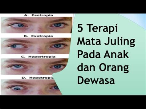 Yuk Coba Inilah 5 Jenis Terapi Mata Untuk Mengatasi Mata Juling Pada