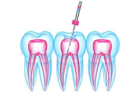 Soothing Downtown Toronto Root Canal Treatment Dental Centres