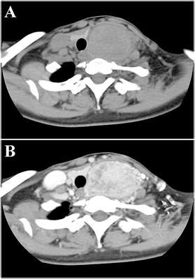 Frontiers Case Report Intraoperative Frozen Section Analysis Of