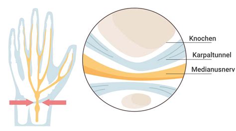 Karpaltunnelsyndrom Symptome Ursachen Und Behandlung