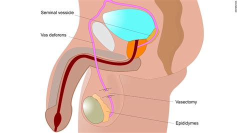 What Is Involved In A Vasectomy Procedure