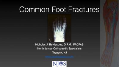 Common Foot Fractures