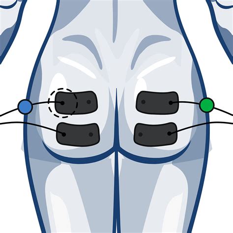 Electrode Placement Compex Uk