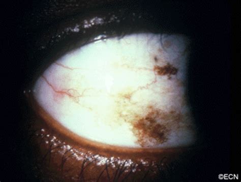 melanosis eye - pictures, photos