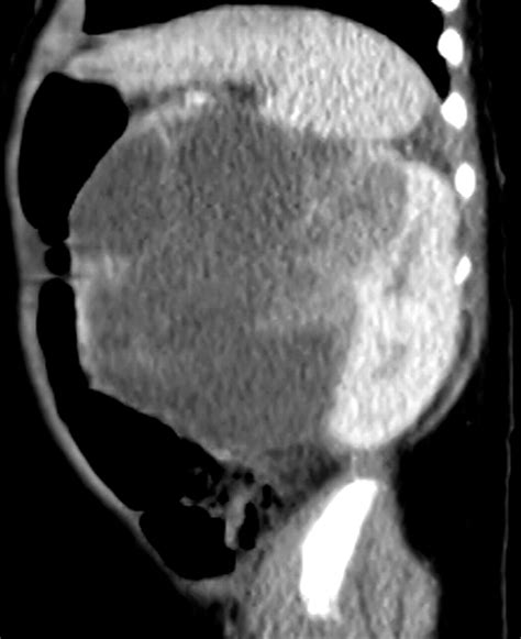 Airp Best Cases In Radiologic Pathologic Correlation Congenital Mesoblastic Nephroma